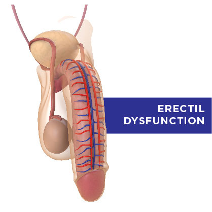 Erectile Dysfunction (Impotence) treatments in Adelaide