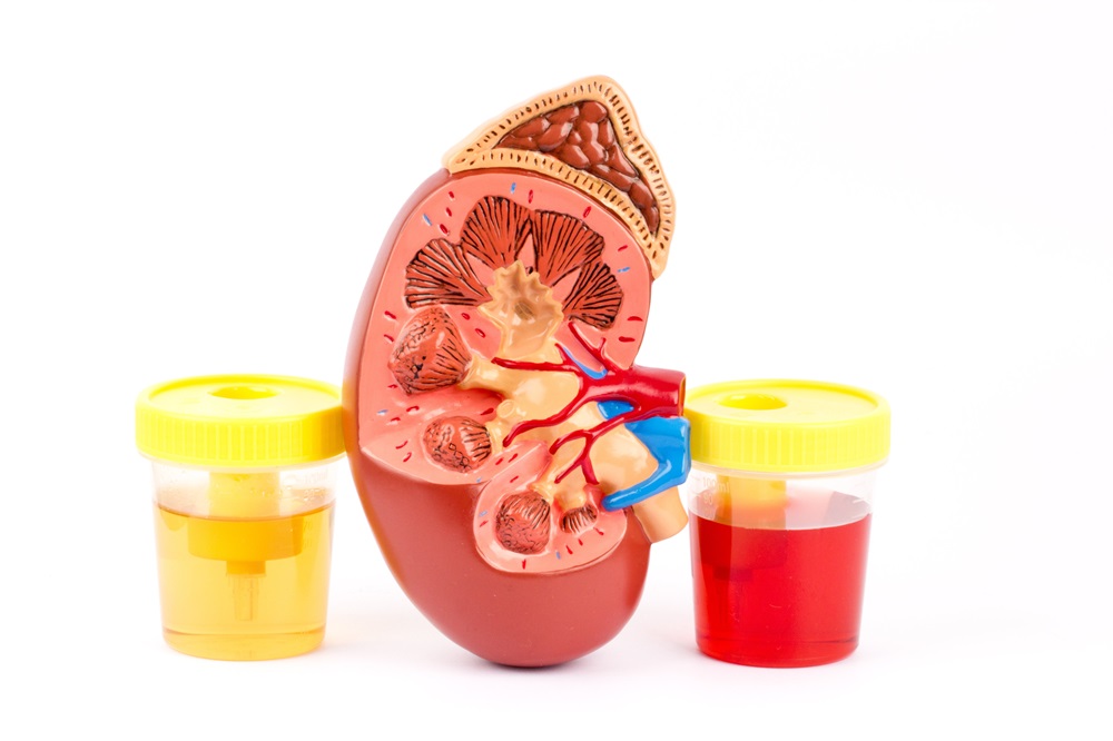 Haematuria