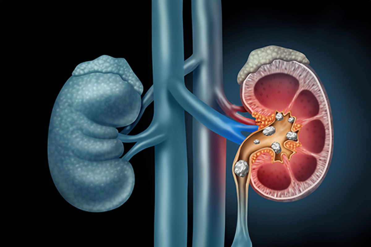 Urinary Stones causes – treatments – symptoms and more