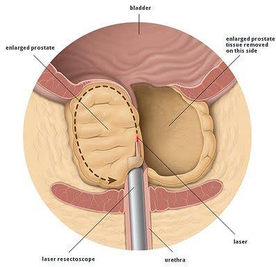 HOLEP (Holmium Laser Enucleation of the Prostate)