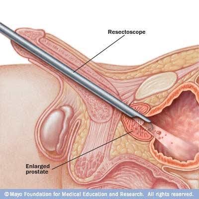 Transurethral Resection of the Prostate (TURP)