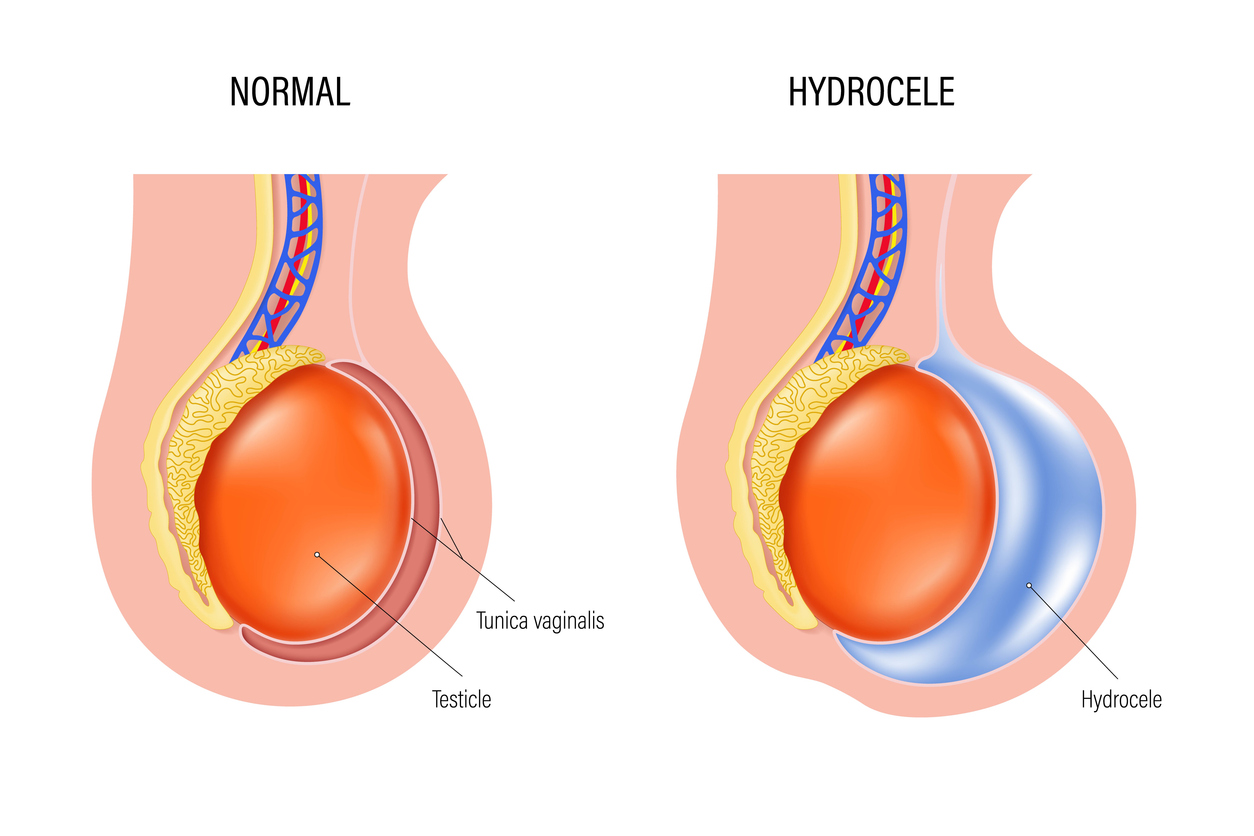 Hydroceles