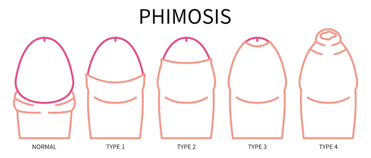 Phimosis