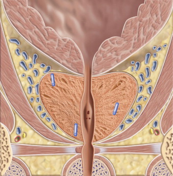 Transperineal Insertion of Gold Seed Fudicial Markers and Rectal Spacer