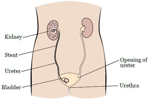 Ureteric Stent Ureteric Stent