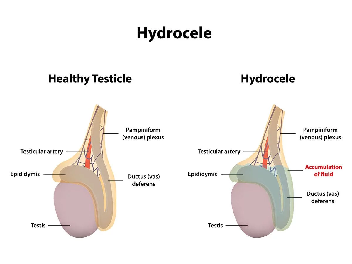 hydrocele repair in adelaide SA