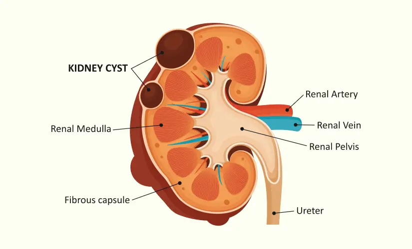kidney-cysts
