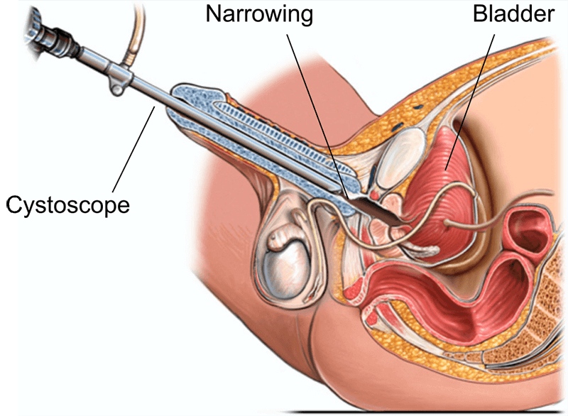 urethrotomy illustration