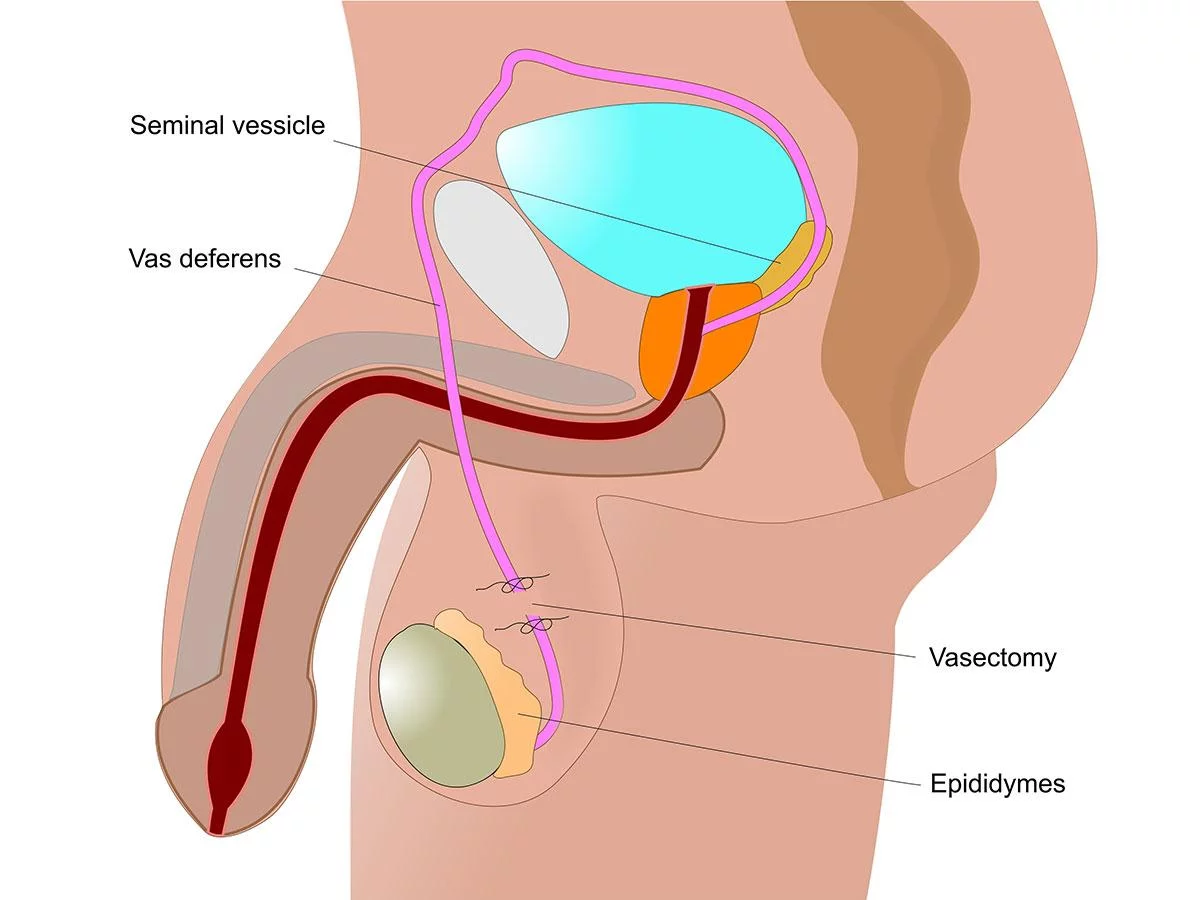 vasectomy